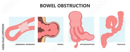 ileus bowel toxic small midgut cecal colon tract Hirschsprung's gastric Ladd band large hiatal hernia cancer tumor swollen crohn's x-ray meckel's twist blocked birth defect infant children pain short