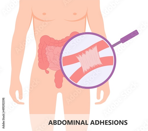 ileus bowel toxic small midgut cecal colon tract Hirschsprung's gastric Ladd band large hiatal hernia cancer tumor swollen crohn's x-ray meckel's twist blocked birth defect infant children pain short photo