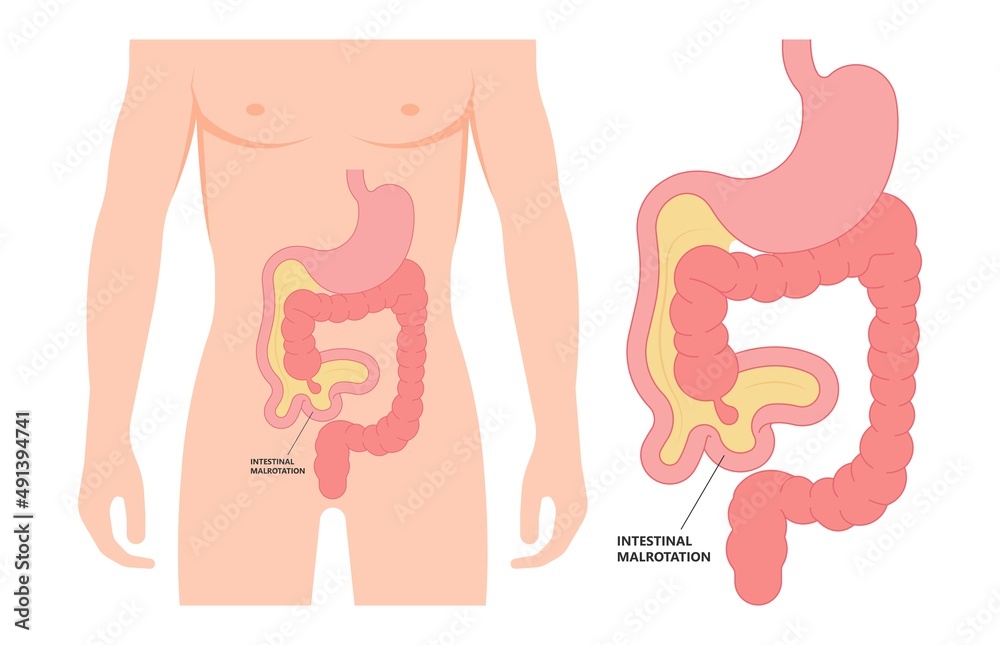 Colon Defect ileus bowel toxic small midgut cecal colon tract Hirschsprung's gastric ...