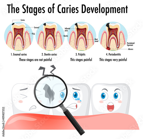 Infographic of human in stages of caries development