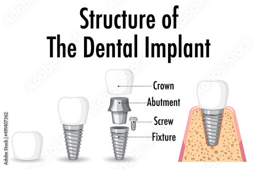 Infographic of human in structure of the dental implant