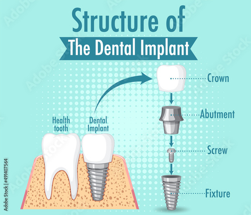 Infographic of human in structure of the dental implant