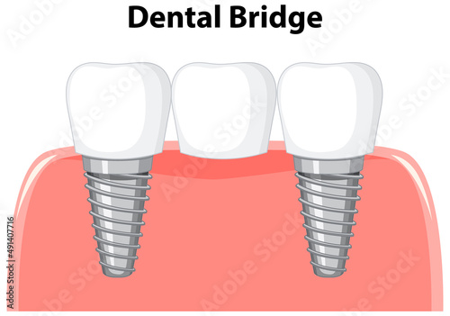 Dental bridge in gum on white background