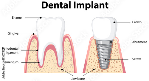 Infographic of human in structure of the dental implant