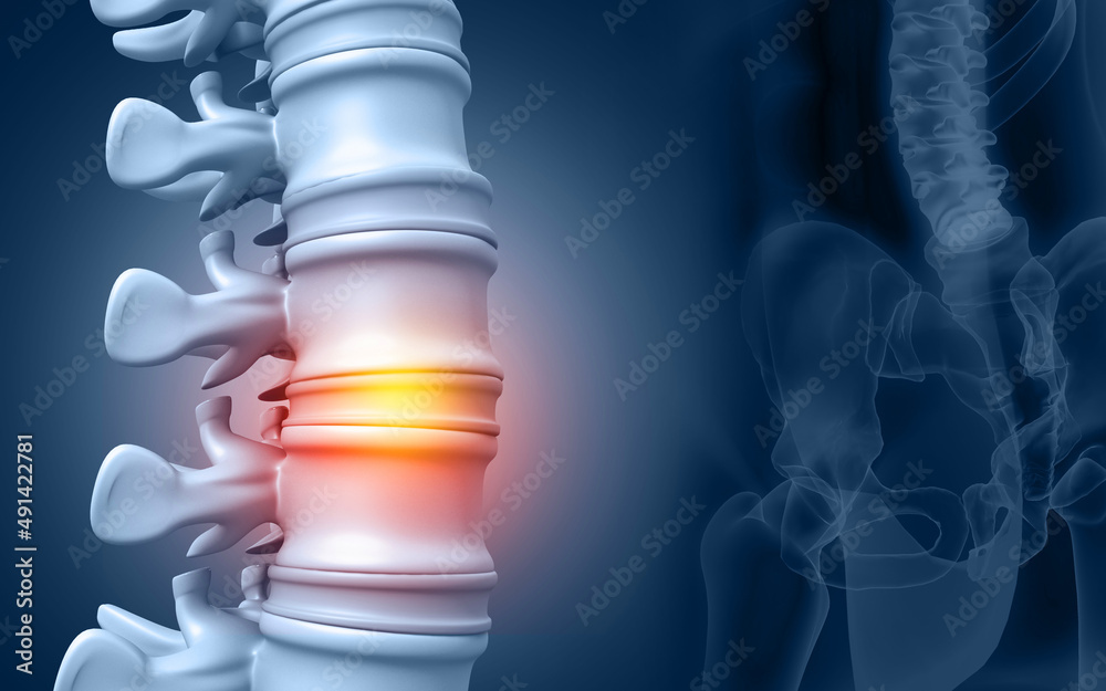 Lumbar intervertebral spine hernia. 3d illustration - obrazy, fototapety, plakaty 
