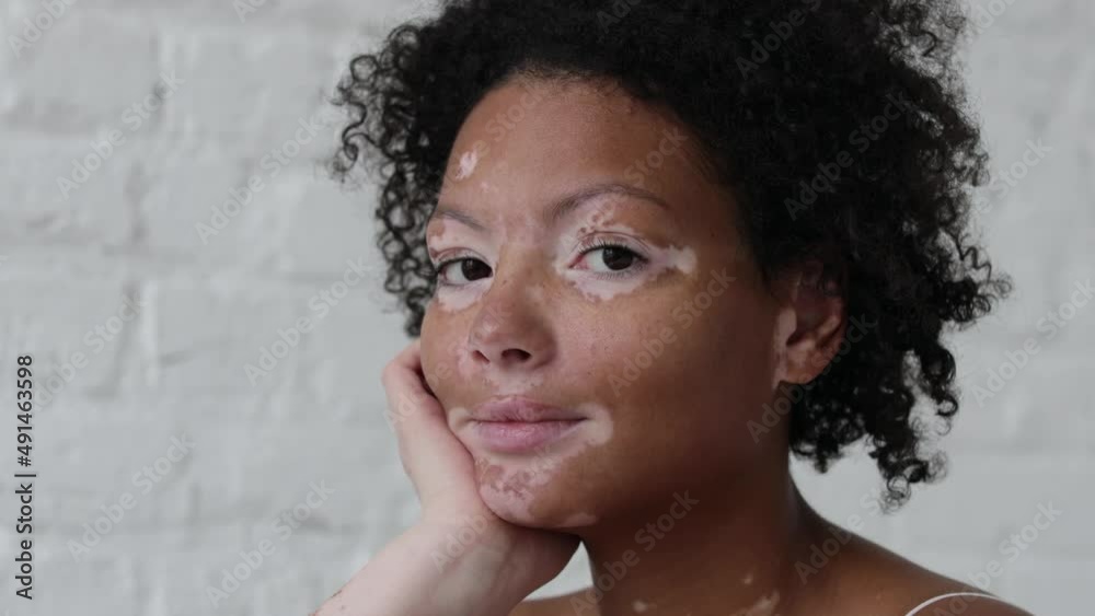 Portrait of smiling afro woman with vitiligo Portrait of smiling afro woman with vitiligo