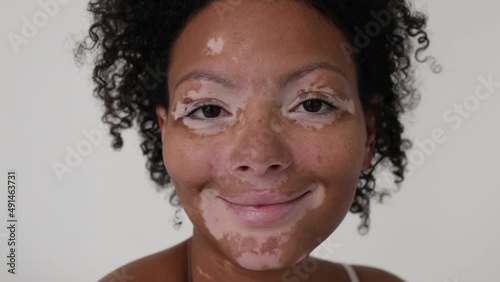 Close up of face of beautiful woman with vitiligo photo