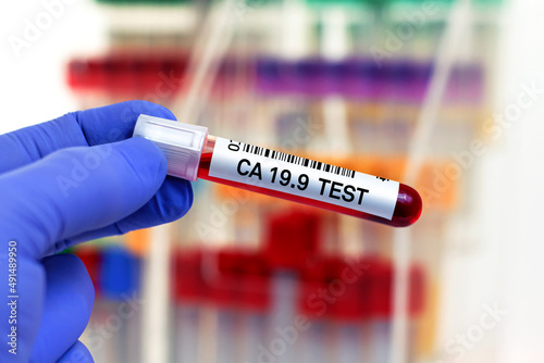 doctor with Blood tube for cancer antigen Ca 19.9 test in lab. Blood sample of patient for tumor marker Ca19.9 test in laboratory photo