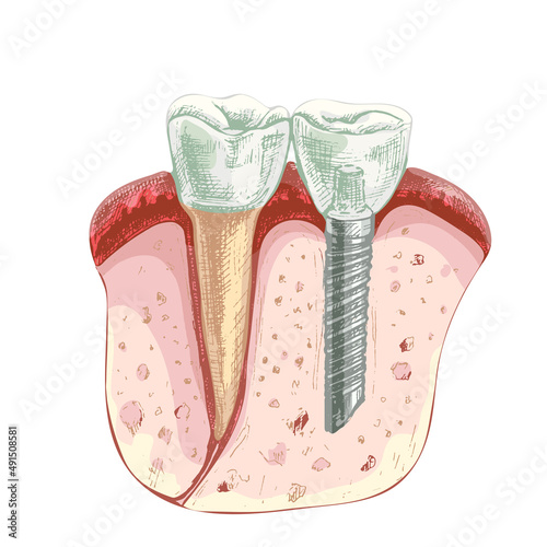 106_dental implant_dentistry. part of gum, healthy tooth and dental implant, dental poster