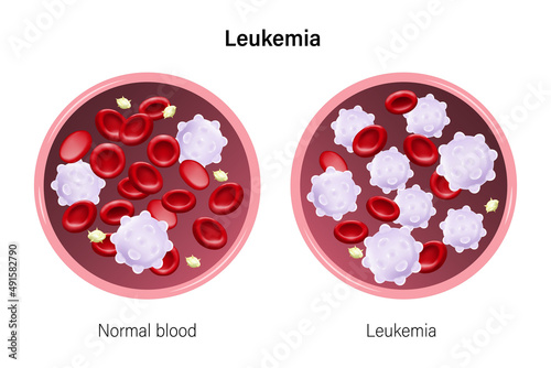 Leukemia. The difference of blood leukemia and normal blood. Red blood cells, White blood cells and platelets. photo
