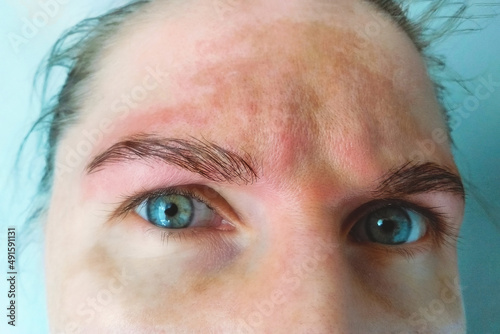 Spot melasma pigmentation facial treatment on face woman. Problem skincare and health concept. Young woman with pigmented skin. photo