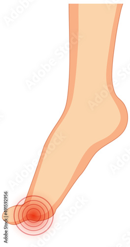 Hallux valgus types on white background