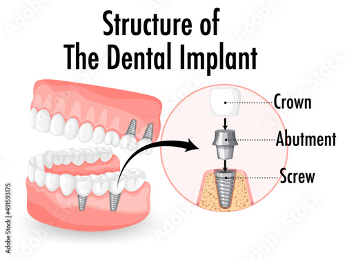 Infographic of human in structure of the dental implant