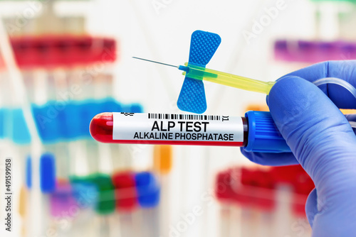doctor with Blood tube for Alkaline Phosphatase ALP test in lab. Blood sample of patient for ALP Alkaline Phosphatase test in laboratory