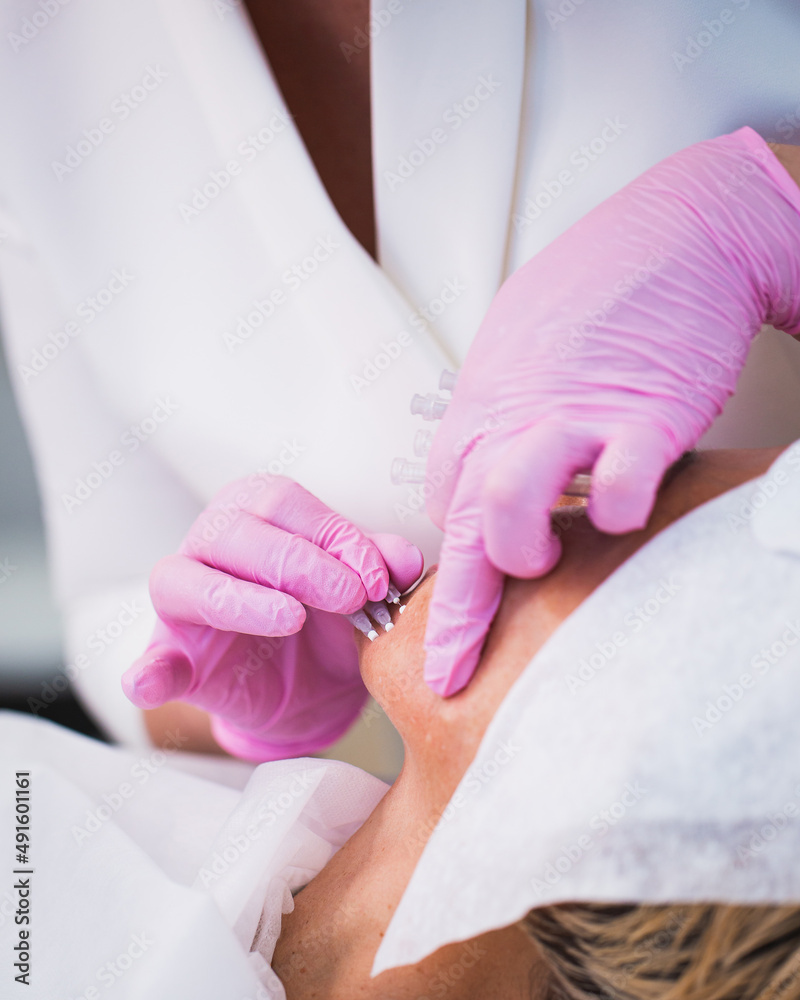 Thread lifting of the face is a minimally invasive mesotherapeutic procedure - the doctor makes a puncture of the skin and introduces synthetic or metal threads - forms and strengthens the skin Thread lifting of the face is a minimally invasive mesotherapeutic procedure - the doctor makes a puncture of the skin and introduces synthetic or metal threads - forms and strengthens the skin