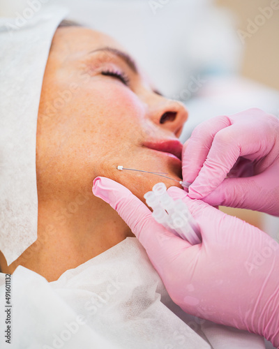 Thread lifting of the face is a minimally invasive mesotherapeutic procedure - the doctor makes a puncture of the skin and introduces synthetic or metal threads - forms and strengthens the skin photo