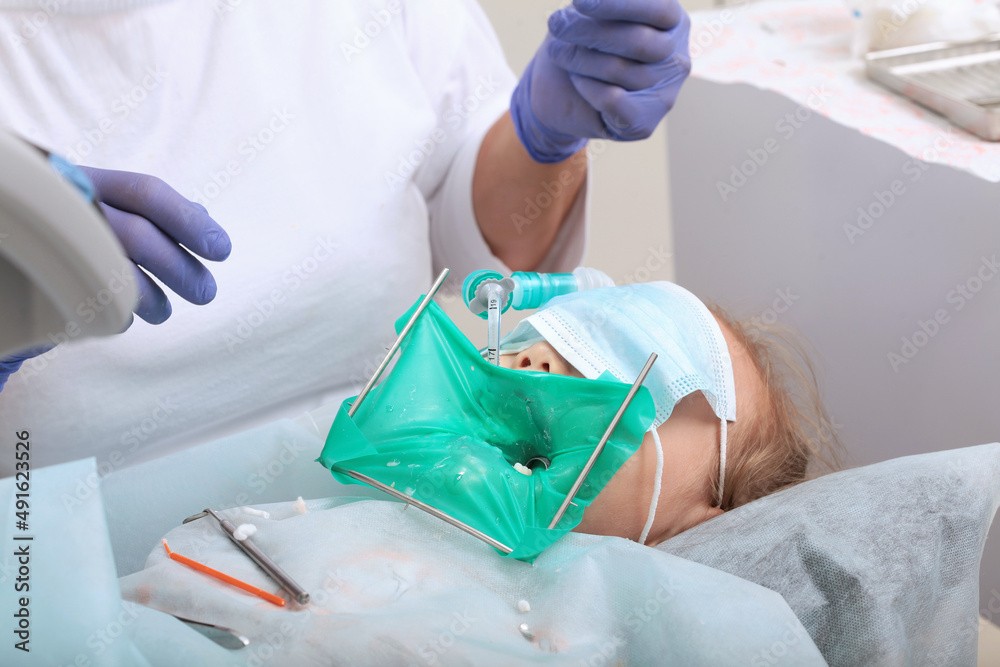 Fototapeta premium Treatment of caries on baby teeth. Modern dental clinic. General anesthesia. Breathing tube. Macro photography. The concept of healthcare.Unrecognizable persons.