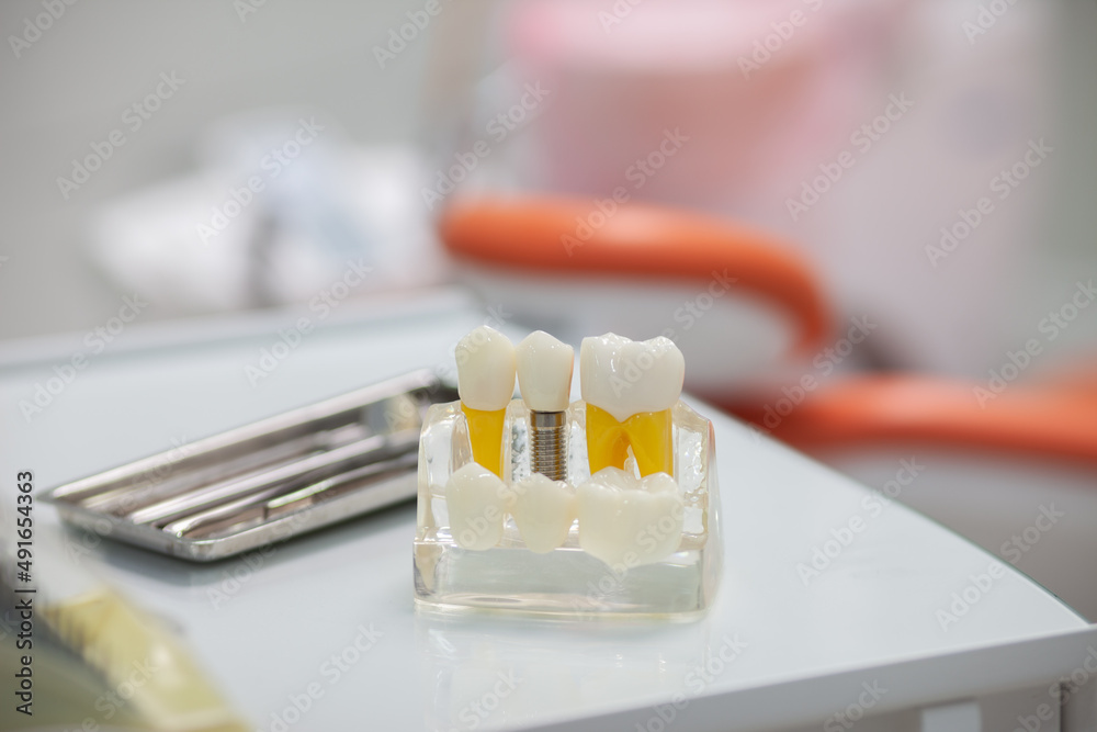 Dental implant model and dental instruments on the table in the dental office Dental implant model and dental instruments on the table in the dental office