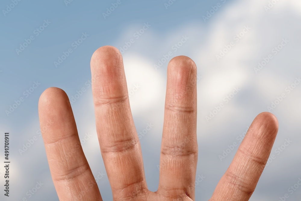 A male hand with Raynaud's syndrome, Raynaud's phenomenon or Raynaud's disease. A male hand with Raynaud's syndrome, Raynaud's phenomenon or Raynaud's disease.
