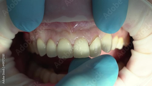fitting of ceramic veneers on the teeth of the upper jaw