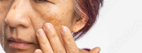 Menopausal women worry about melasma on face. photo