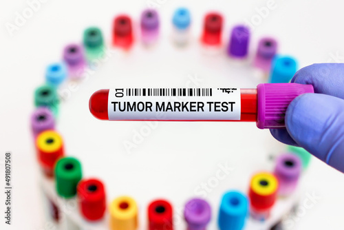doctor with blood tube labeled with Tumor marker for analysis of cancer biomarkers test. Blood tube for Study of Tumor Marker test in biochemistry lab photo