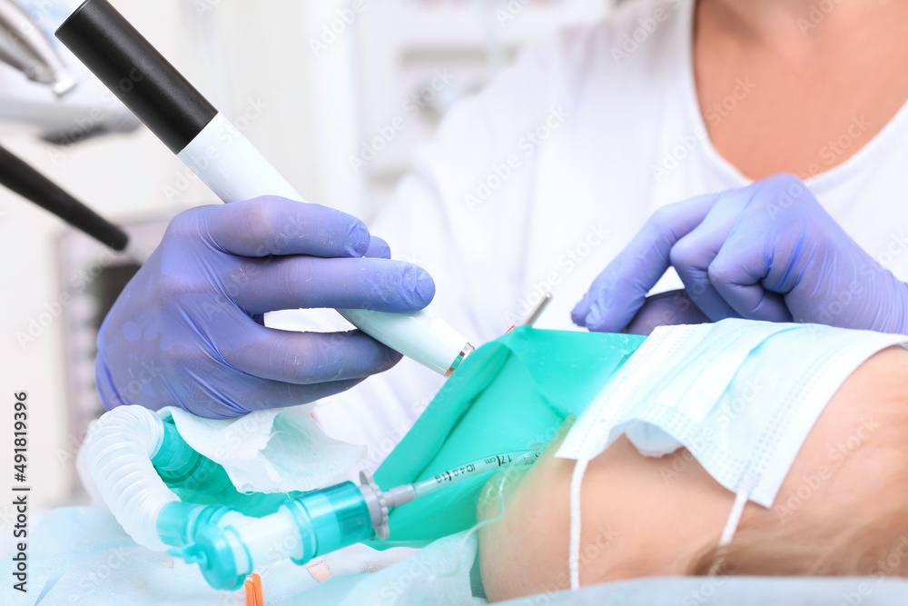 Treatment of caries of baby teeth under general anesthesia. Breathing tube. Photo in a real operating room. Unrecognizable faces. Treatment of caries of baby teeth under general anesthesia. Breathing tube. Photo in a real operating room. Unrecognizable faces.