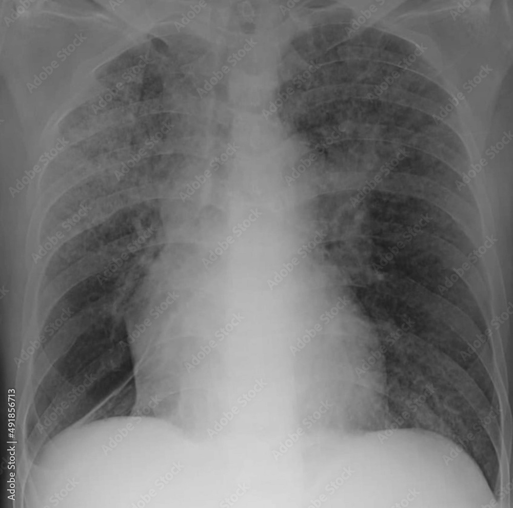 chest xray image of miliary nodules Stock Photo Adobe Stock