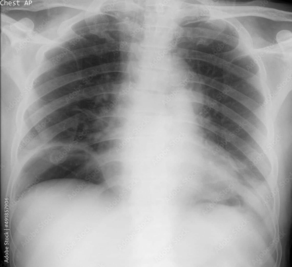 Chest x ray image of pneumoperitoneum ,free air on abdomen as luscent cresent lesion sub diafragma Chest x ray image of pneumoperitoneum ,free air on abdomen as luscent cresent lesion sub diafragma