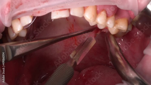 a dental surgeon takes tissue flaps with a scalpel and tweezers from the jaw tubercle