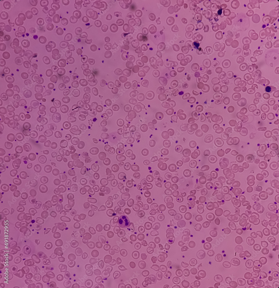 Hereditary hemolytic anemia with thrombocytosis, inherited blood