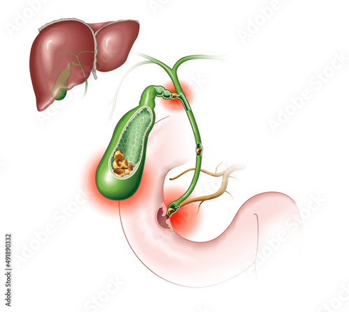 Gallstone disease. gallstones blocking bile duct and pancreatic duct. Labeled Illustration photo