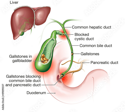 Gallstone disease. gallstones blocking bile duct and pancreatic duct. Labeled Illustration photo