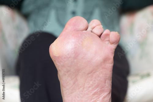 Hallux valgus, bunion in foot  is normally caused by genetic or wearing too tight shoes and high heels.