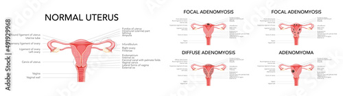 Fényképezés Adenomyosis illness set - focal, diffuse, adenomyoma and normal uterus with inscriptions