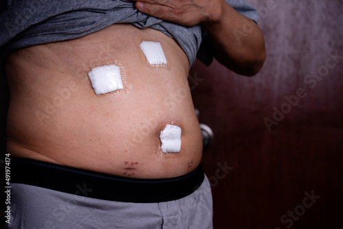 Three hole of Laparoscopic incision cuts the gallbladder