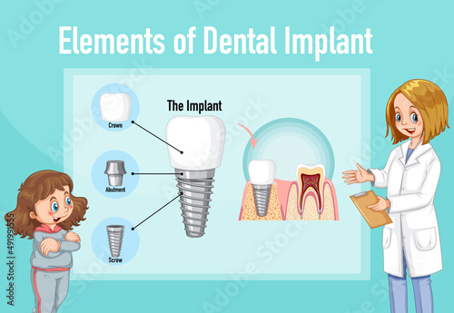 Infographic of human in structure of the dental implant