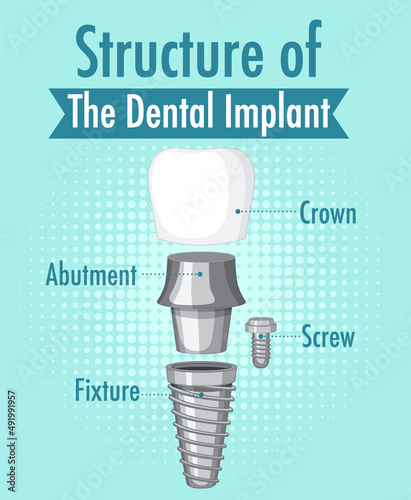 Infographic of human in structure of the dental implant