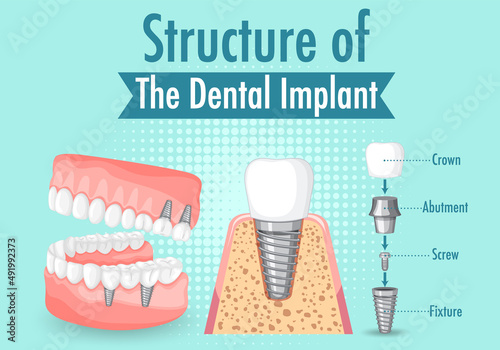 Infographic of human in structure of the dental implant