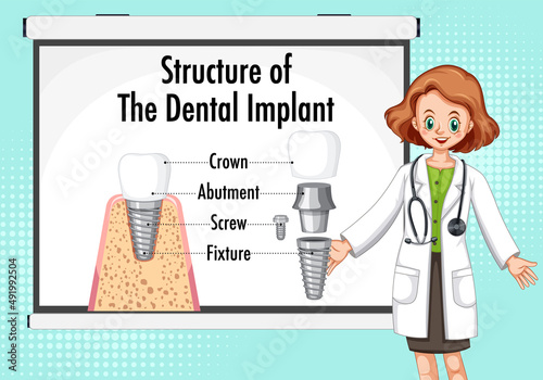Infographic of human in structure of the dental implant