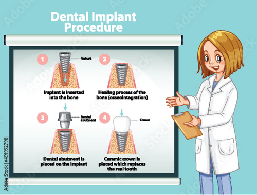 Infographic of human in dental implant procedure