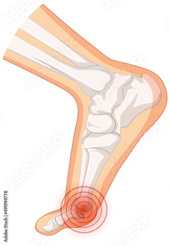 Hallux valgus types on white background