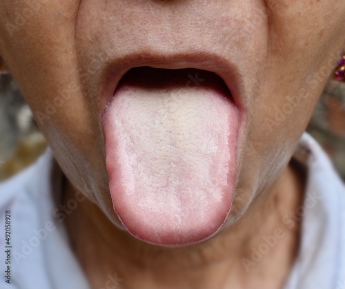 Fotografie, Obraz Coated tongue or white tongue. Loss of taste called ageusia.