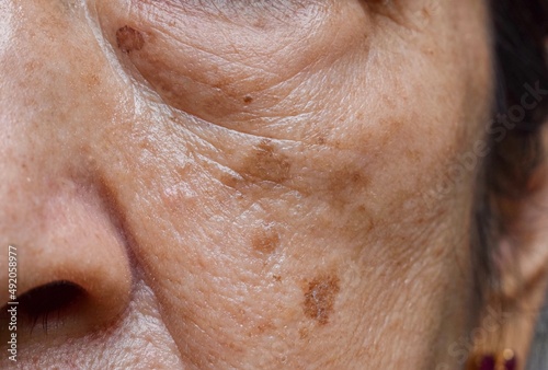Small brown patches called age spots on face of Asian elder woman. They are also called liver spots, senile lentigo, or sun spots. photo