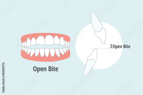 icon dental problem. vectorial illustration Open bite