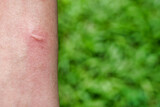 An insect bite wound on the skin of the arm.