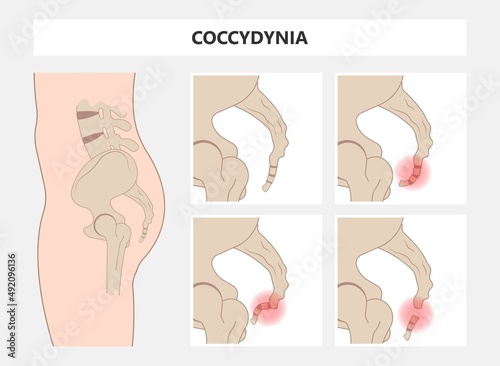 Tail bone pain floor hip spine sitting down back leg fall slip broken poor chair lower trauma tumor symptom joint surgery coccalgia good work from home computer ergonomic seating sacroiliitis  photo