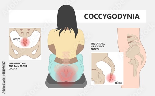 Tail bone pain floor hip spine sitting down back leg fall slip broken poor chair lower trauma tumor symptom joint surgery coccalgia good work from home computer ergonomic seating sacroiliitis 