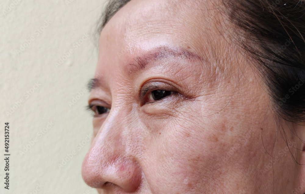 Portrait showing flabbiness and blemishes skin beside the face of the woman, ptosis on the eyelid, concept health care.