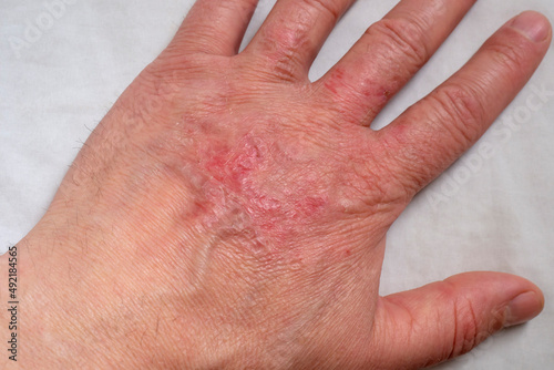 Healing burns on the arm. Scars on the skin of the hand after a burn.